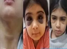 شکنجه و آزار دختربچه ۹ ساله سنندجی توسط  نامادری/ نامادری با گوشت کوب به سر کودک می کوبید و با چنگال  بدنش را می سوزاند