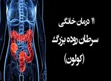 سرطان روده بزرگ چگونه ایجاد می شود و راه های پیشگیری از آن چیست؟ 