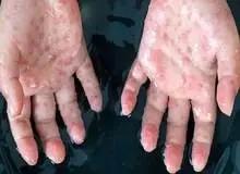 آبله میمون به ایران رسید؟!/شکوک به آبله میمون در ایران/ آزمایش ۳ نفر منفی شد