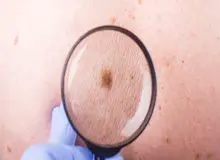 شایع ترین سرطان در کشور