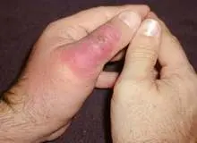 سالیانه ۶۰ هزار گزیدگی عقرب و شش هزار گزش مار در ایران گزارش می شود