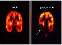 ۷۰۰ هزار نفر در ایران بیماری صرع دارند