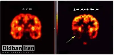 ۷۰۰ هزار نفر در ایران بیماری صرع دارند