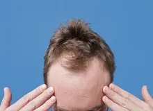 کدام ریزش مو در مردان شایع‌تر است؟