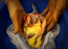 با روش های کاهش چربی اطراف "قلب" آشنا شوید