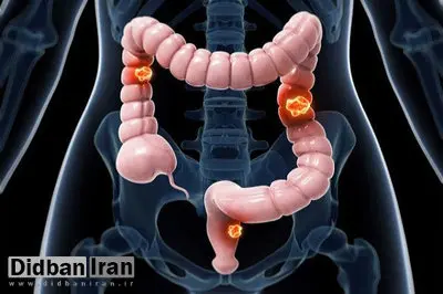 ۸ ماده غذایی برای پیشگیری از یک نوع سرطان گوارشی
