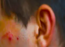 فوت یک شهروند ایرانشهری براثر ابتلا به آبله میمون صحت ندارد
