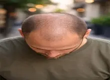 عوامل اصلی کچلی در ایران شناسایی شد