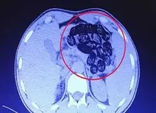 کشف ۹۰ بسته مواد مخدر از معده و روده یک بیمار در کرج
