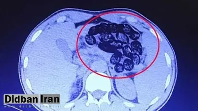 کشف ۹۰ بسته مواد مخدر از معده و روده یک بیمار در کرج