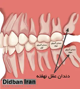 دندان عقل را بی دلیل نکشید