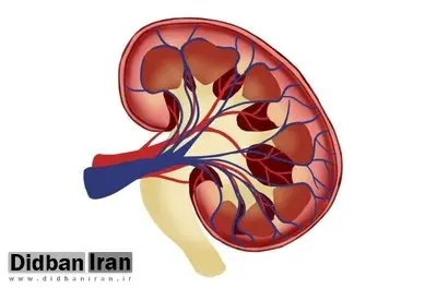 علائم، درمان و باورهای غلط درباره سنگ کلیه