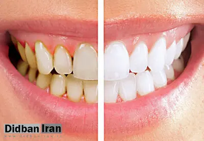 ۵ اشتباه رایجی که باعث زردی دندانها میشود