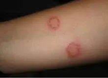 با این روش‌ها از ابتلا به سالک جلوگیری کنید