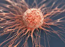 واکسن گونه‌های پرخطر HPV باید وارد واکسیناسیون عمومی شود