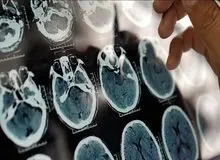 ۵ علامت هشدار دهنده پیری زودرس مغز