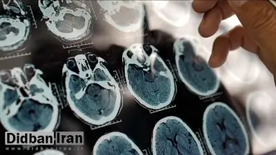 ۵ علامت هشدار دهنده پیری زودرس مغز