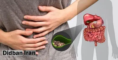 رفع خطر سنگ کیسه صفرا با مصرف آنتی‌اکسیدان‌ها
