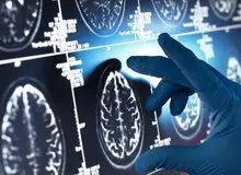 با این داروی گیاهی از آلزایمر در امان بمانید