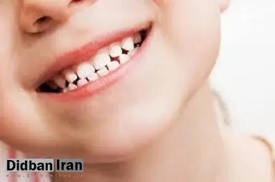 رحیمی: ۹۰ درصد کودکان ایرانی با دندان‌های پوسیده به مدرسه می‌روند
