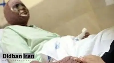 اسیدپاشی مرد ۲۸ ساله روی همسرش در استان گیلان