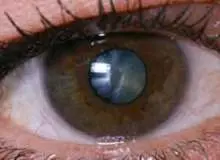  کشف آزمون های جدیدی برای تشخیص بیماری گلوکوم