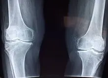 توصیه‌های طب ایرانی برای جلوگیری از پوکی استخوان