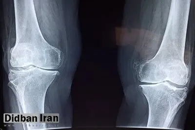 توصیههای طب ایرانی برای جلوگیری از پوکی استخوان