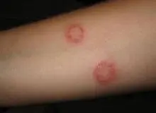 ابتلای ۴۸۰۰ نفر به سالک در سال جاری