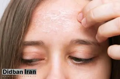 فصلی که دوست پوست ما نیست/ برای آبرسانی پوست در زمستان چه کنیم؟