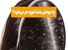 ۵عامل موثر در ایجاد  شوره سر