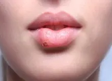 ویروس تبخال می‌تواند ریسک ابتلا به زوال عقل را دو برابر کند