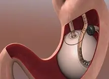 هشدار سازمان غذا و داروی آمریکا درباره خطر بالون معده