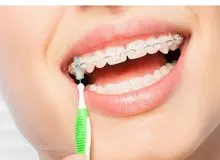 مزایای ارتودنسی دیمون نسبت به بقیه روش های ارتودنسی