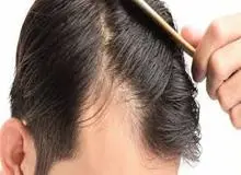 با ۵خوراکی‌ مهم رای جلوگیری از ریزش مو آشنا شوید 