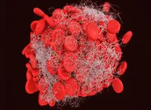 موفقیت ژن درمانی در توقف خونریزی بیماران مبتلا به هموفیلی بی